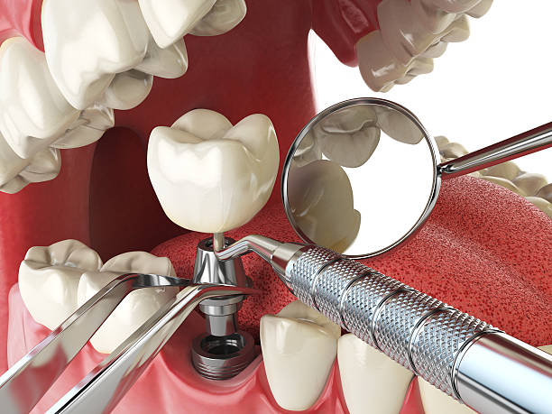 Best Broken Tooth Emergency  in Rden, WA